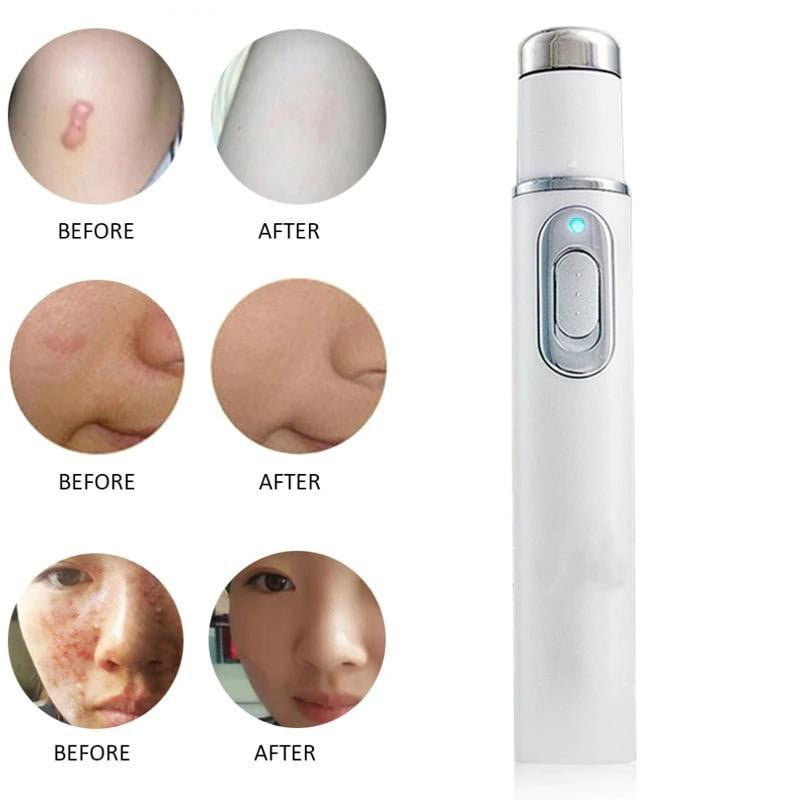 Acne Laser Pen Portable Wrinkle Removal Machine Durable Soft Scar Remover Blue Light Therapy Pen - TRIPLE AAA Fashion Collection